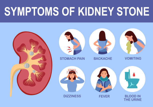 illustrazioni stock, clip art, cartoni animati e icone di tendenza di infografica sul sintomo del calcolo del calcolo renale nell'illustrazione vettoriale del design piatto. - kidney stone