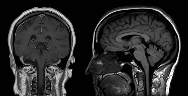 image de tomodensitométrie cérébrale sur imagerie par résonance magnétique (irm) - anatomie cerveau photos et images de collection