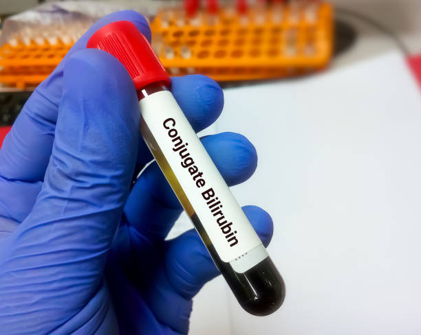 istock Scientist hold blood sample for conjugated Bilirubin test 1344355396
