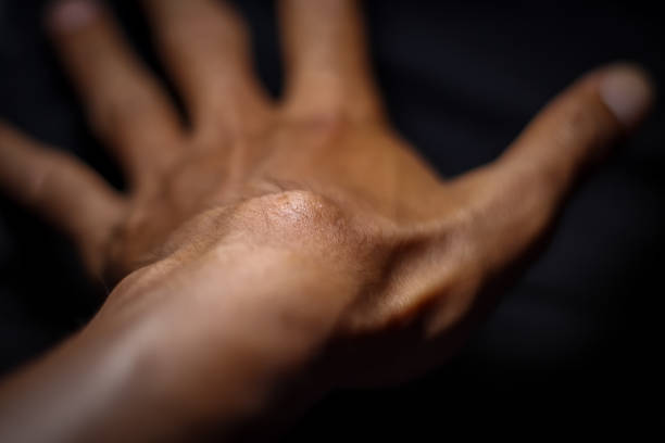 istock Ganglion Cyst from hard work 1344405915