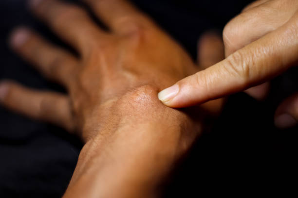 istock Ganglion Cyst from hard work 1344405954
