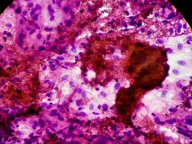Photo of FNAC of lymph nodes tissue Cytology microscopic 100x show Microbacterium Tuberculosis TB. Lymph node TB.