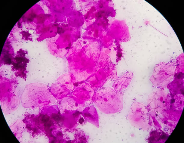 高膣綿棒(hvs)グラム染色顕微鏡100xは、いくつかの膿細胞および上皮細胞を示す。グラム陽性のジプロコクチの数が多く、数グラムの陰性棒形状細菌。 - staphylococcus epidermidis ストックフォトと画像