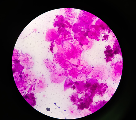 High Vaginal Swab (HVS) gram stain microscopic 100x show few pus cells and epithelial cells. Large number of gram positive Diplococci and few gram negative rods shape bacteria at medical laboratory.