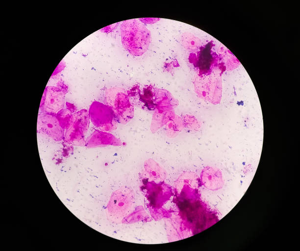 istock Prostatic Smear (P/S) gram stain microscopic 100x show few pus cells and epithelial cells. Large number of gram positive Diplococci and few gram negative rods shape bacteria. 1344422339