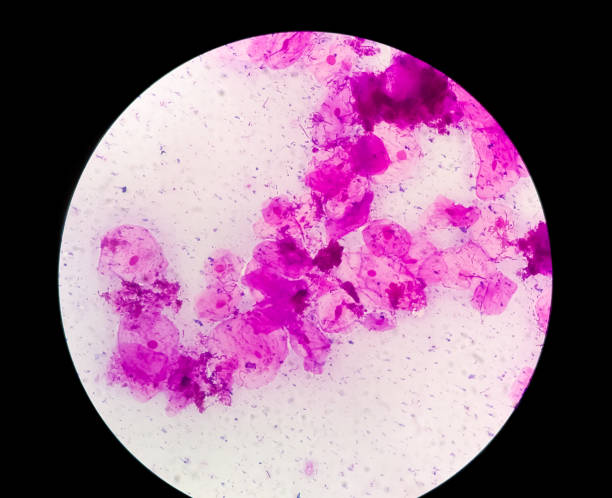 istock Throat Swab (T/S) gram Stain microscopic show Microbacterium Tuberculosis TB. 1344422381
