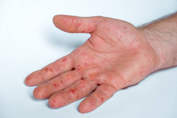 Painful rash, red spots blisters on the hand. Close up Allergy rash, human hands with dermatitis, Health problem. Ill eczema skin of patient. Viral Diseases. Red rashes on palm, Enterovirus, Varicella Painful rash, red spots blisters on the hand. Close up Allergy rash, human hands with dermatitis and Health problem. Ill eczema skin of patient. Viral Diseases. Red rashes on the palm. Enterovirus. coxsackie hand foot and mouth disease stock pictures, royalty-free photos & images