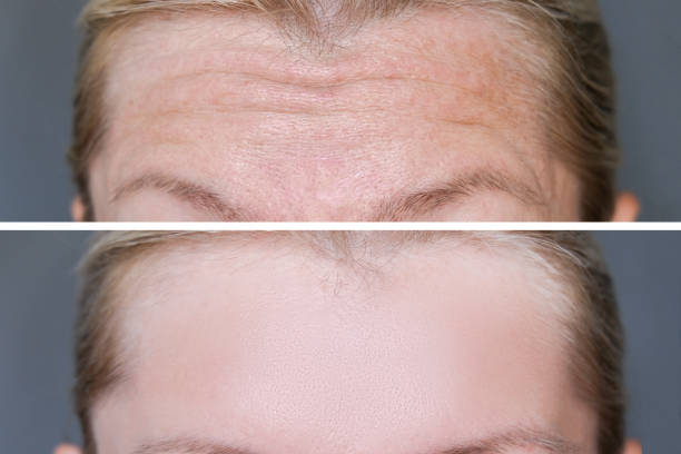 Deep mimic forehead wrinkles before and after treatment, smoothing and correction of face wrinkles as a result of rejuvenation or injection botulinum toxin Deep mimic forehead wrinkles before and after treatment, smoothing and correction of face wrinkles as a result of rejuvenation or injection botulinum toxin. botox before and after stock pictures, royalty-free photos & images
