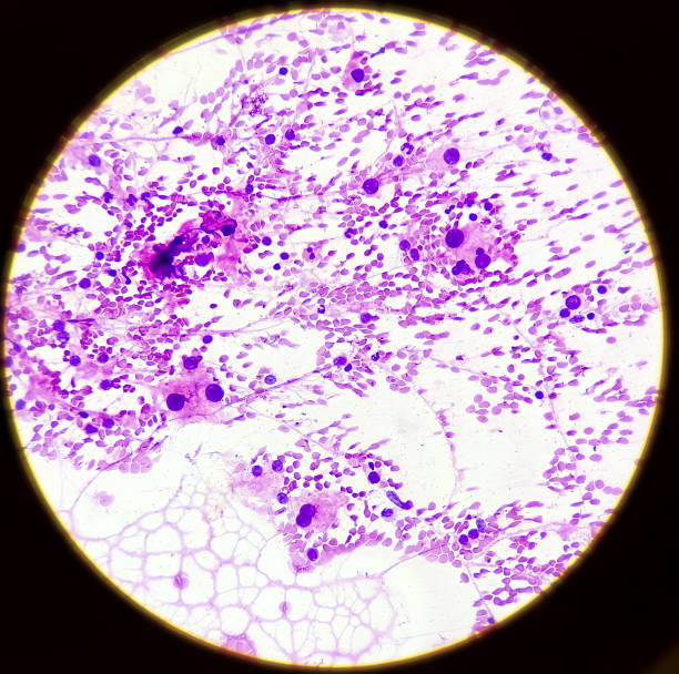 istock Hepatocellular dysplasia, cellular enlargement, nuclear pleomorphism, and multinucleation, light micrograph, photo under microscope 1344717634