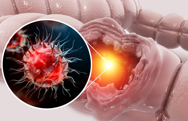 Colon cancer. Cancer attacking cell. Colon disease concept. 3d illustration stock photo