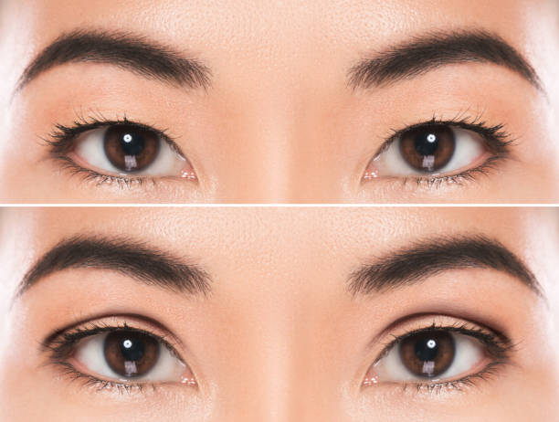 東アジアの眼瞼形成術または二重眼瞼手術 - lid ストックフォトと画像