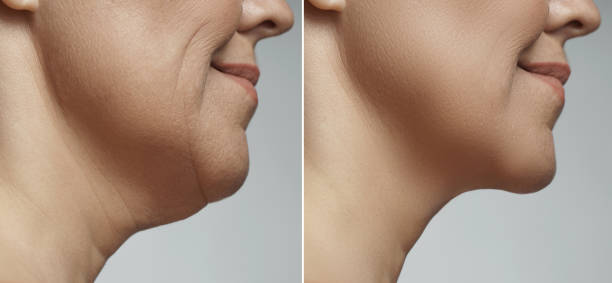 Double chin removal, facelift and neck liposuction Difference after plastic surgery. Double chin removal, facelift and neck liposuction. drooping photos stock pictures, royalty-free photos & images
