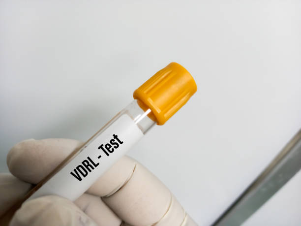 blood samples for vdrl(venereal disease research laboratory) test in the test tube vector, screening test for syphilis - venereal imagens e fotografias de stock