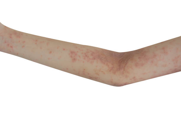 istock Skin rash on the arms isolated a white background. 1344968000