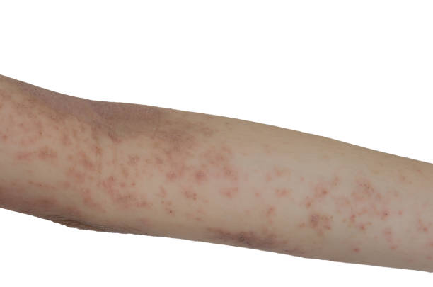istock Skin rash on the arms isolated a white background. 1344968003