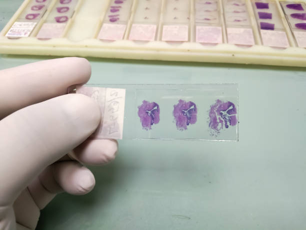 istock Histological Hematoxylin and eosin stained microscopic slides. Isolated in laboratory, histopathology. To diagnosis cancer cells, adenocarcinoma at medical laboratory. 1345055160