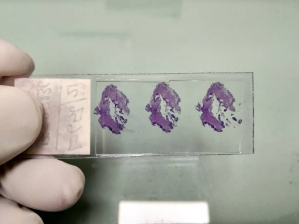 istock Histological Hematoxylin and eosin stained microscopic slides. Isolated in laboratory, histopathology. To diagnosis cancer cells, adenocarcinoma at medical laboratory. 1345055176