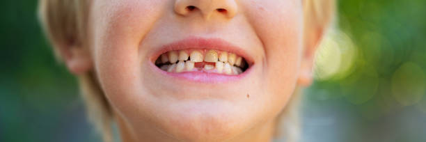 istock Wide view image of a toddler boys smile with missing milk teeth 1345081229