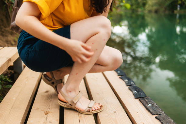 punture. una donna accovacciata, graffiandosi le gambe morse con le mani. gambe in un primo piano di eruzione cutanea rossa. parco estivo e fiume sullo sfondo - flea foto e immagini stock