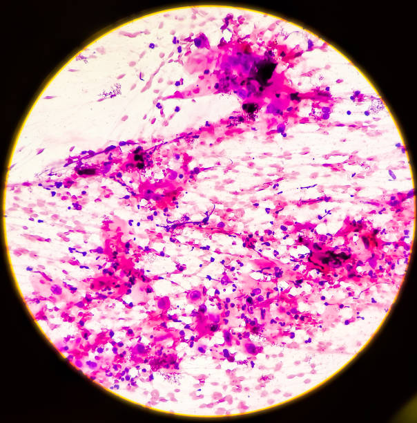 istock Microscopic view of Metastatic squamous cell carcinoma, atypical squamous epithelial cells, Atypical keratinized cells are noted, sample aspirate from inguinal lymph node by FNAC, 40x view 1345266493