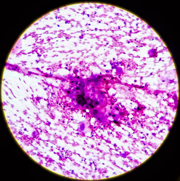 istock Microscopic view of Metastatic squamous cell carcinoma, atypical squamous epithelial cells, Atypical keratinized cells are noted, sample aspirate from inguinal lymph node by FNAC, 40x view 1345266495