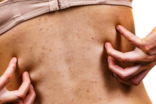 istock Woman with skin problem acne on back 1345333992