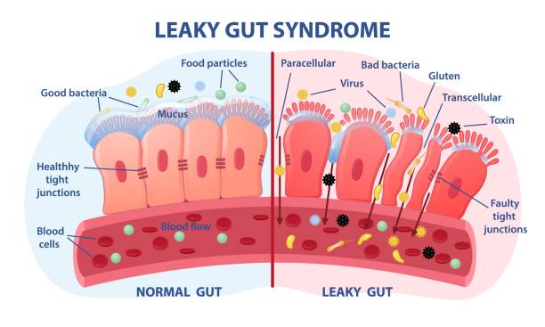 Leaky gut Syndrome concept Leaky gut Syndrome concept. Comparison of healthy organ and inflamed tissue cells. Diseases of gastrointestinal tract. Toxins and viruses. Cartoon flat vector illustration isolated on white background abdomen stock illustrations