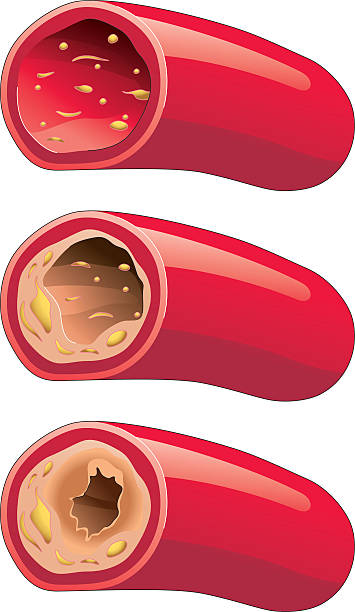ilustraciones, imágenes clip art, dibujos animados e iconos de stock de aterosclerosis - human artery