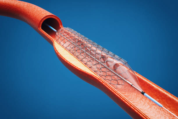 3d medizinische illustration des ballon-stent-angioplastie-verfahrens - angioplasty stock-fotos und bilder