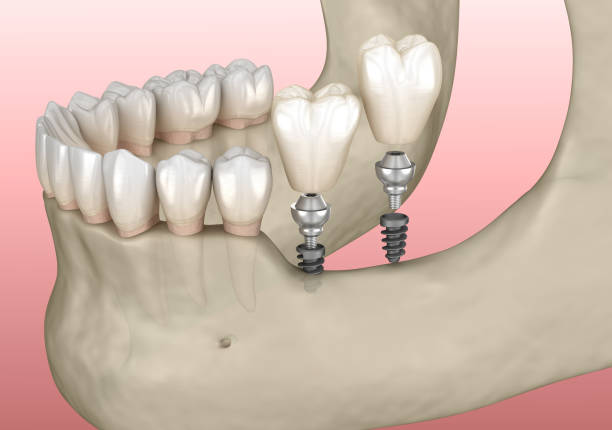 istock Implantation with mini implants in to recessed jaw bone: Medically accurate 3D illustration 1345444896