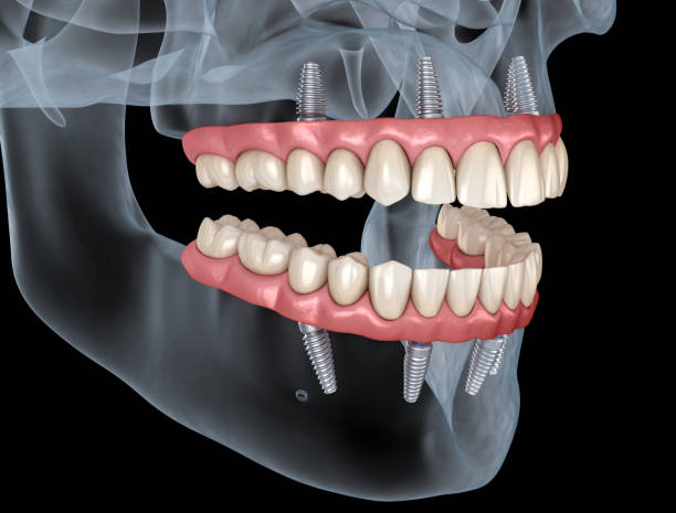 prótesis maxilar y mandibular con encía all on 4 sistema soportado por implantes. ilustración 3d médicamente precisa de dientes y dentaduras humanas - teeth implant fotografías e imágenes de stock