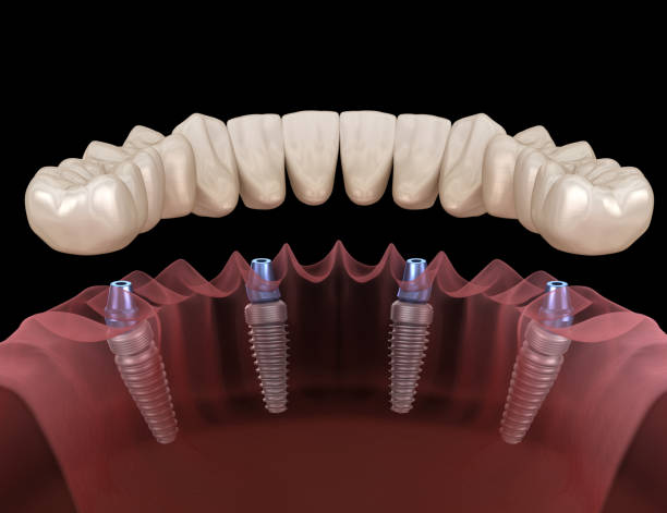 mandibular prosthesis all on 4 system supported by implants. medically accurate 3d illustration of human teeth and dentures concept - implantat imagens e fotografias de stock