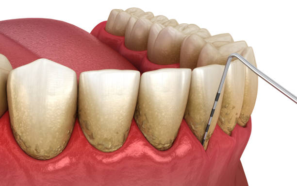 istock Gum recession test. Medically accurate 3D illustration 1345444972