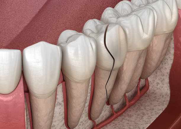 istock Cracked tooth, splitted. Medically accurate 3D illustration 1345444980