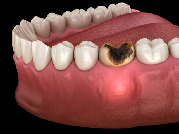 periostitis zahn - lump auf zahnfleisch über zahn. medizinisch genaue zahnärztliche 3d-illustration - abszess stock-fotos und bilder