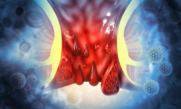 haemorrhoids (piles) on scientific background. 3d illustration - hemorrhoid imagens e fotografias de stock