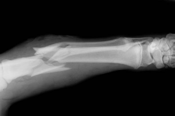 x-ray of a broken bone - knochenbruch stock-fotos und bilder