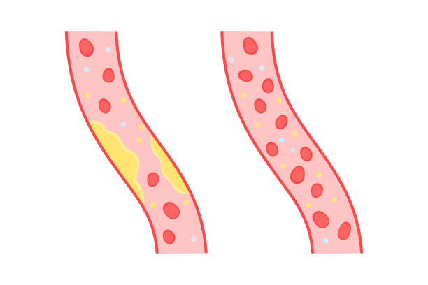 color blood vessels with cholesterol and healthy color blood vessels with cholesterol and healthy. concept of compound cells, diagnosis hypertension, cardiology. educational scheme for studying the disease. flat design sign on white background clogged artery stock illustrations