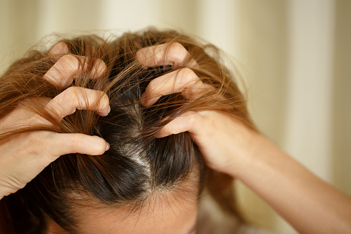 Una mujer tiene problemas con el cabello y el cuero cabelludo photo