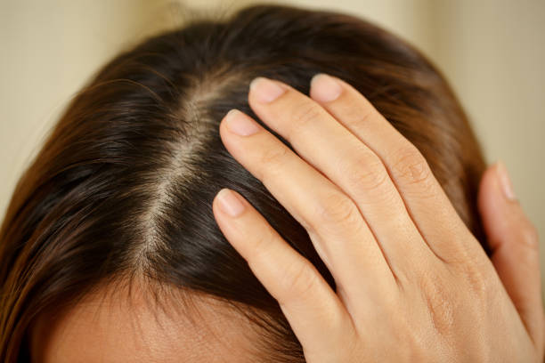 A woman has problems with hair and scalp stock photo
