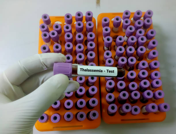 amostra de sangue para teste de talassemia (alfa ou beta). hb eletroforese. doença genética da herança. - célula alfa - fotografias e filmes do acervo