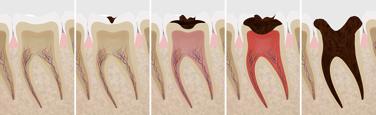 3D rendering of a cross section of caries progression