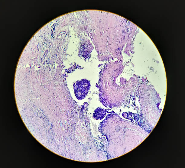 inflammation granulomateuse chronique histologiquement compatible avec la tuberculose. - microscope view photos et images de collection