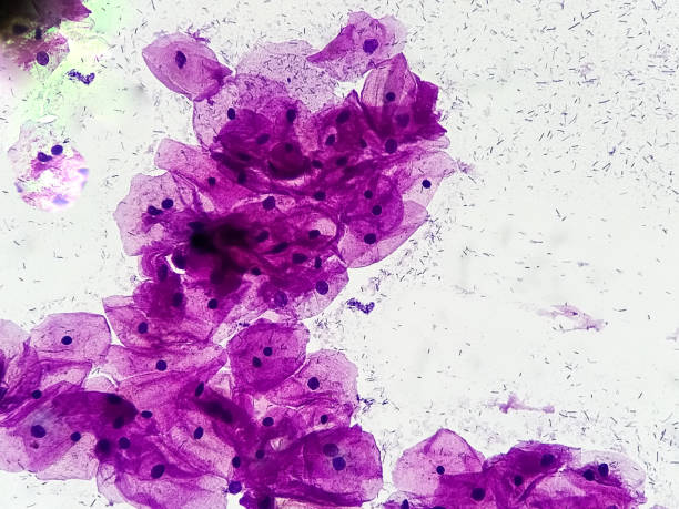 células epiteliais escamosas. micrografia - adenocarcinoma - fotografias e filmes do acervo