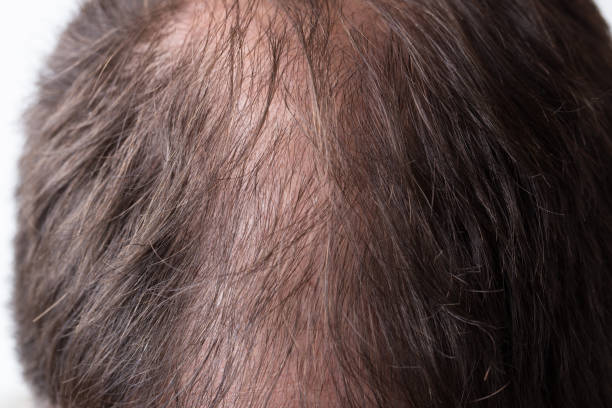Close-up balding head of a young man on a white isolated background.