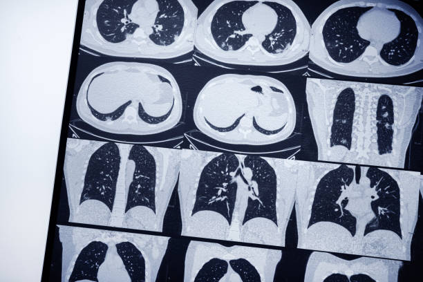 istock Tests and examinations for pneumonia, detection of coronavirus. 1345796801