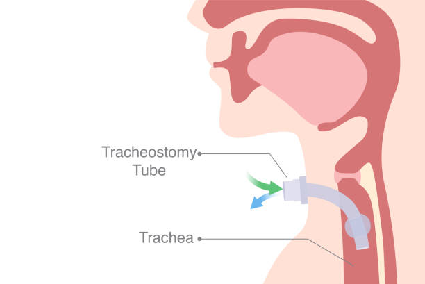 istock Tracheostomy is an opening created at the front of the neck for inserted a siliconized tube into the trachea to help breathe. 1345803130