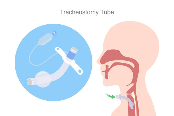 Tracheostomy Tube Is A Device To Help A Patient Who Can Not Breathe With  Nose And Mouth Stock Illustration - Download Image Now - iStock