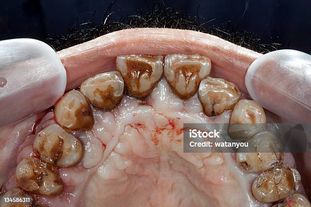 Periodontitis Stock Photo - Download Image Now - Blood, Dental Calculus, Dental Health