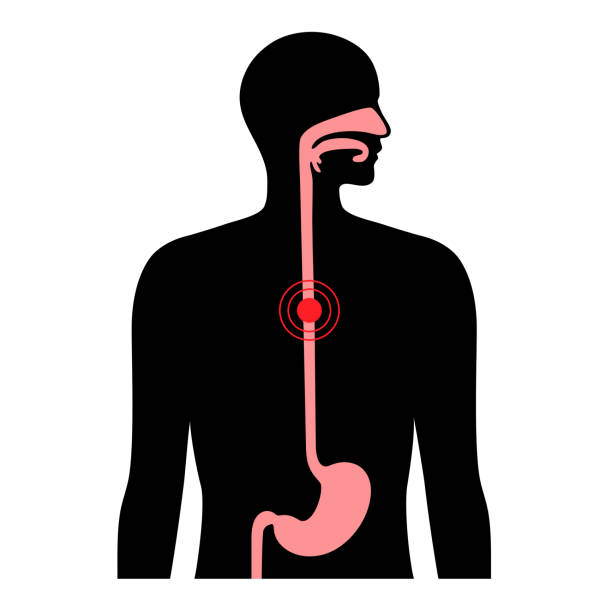 illustrazioni stock, clip art, cartoni animati e icone di tendenza di concetto di cancro esofageo - esofago